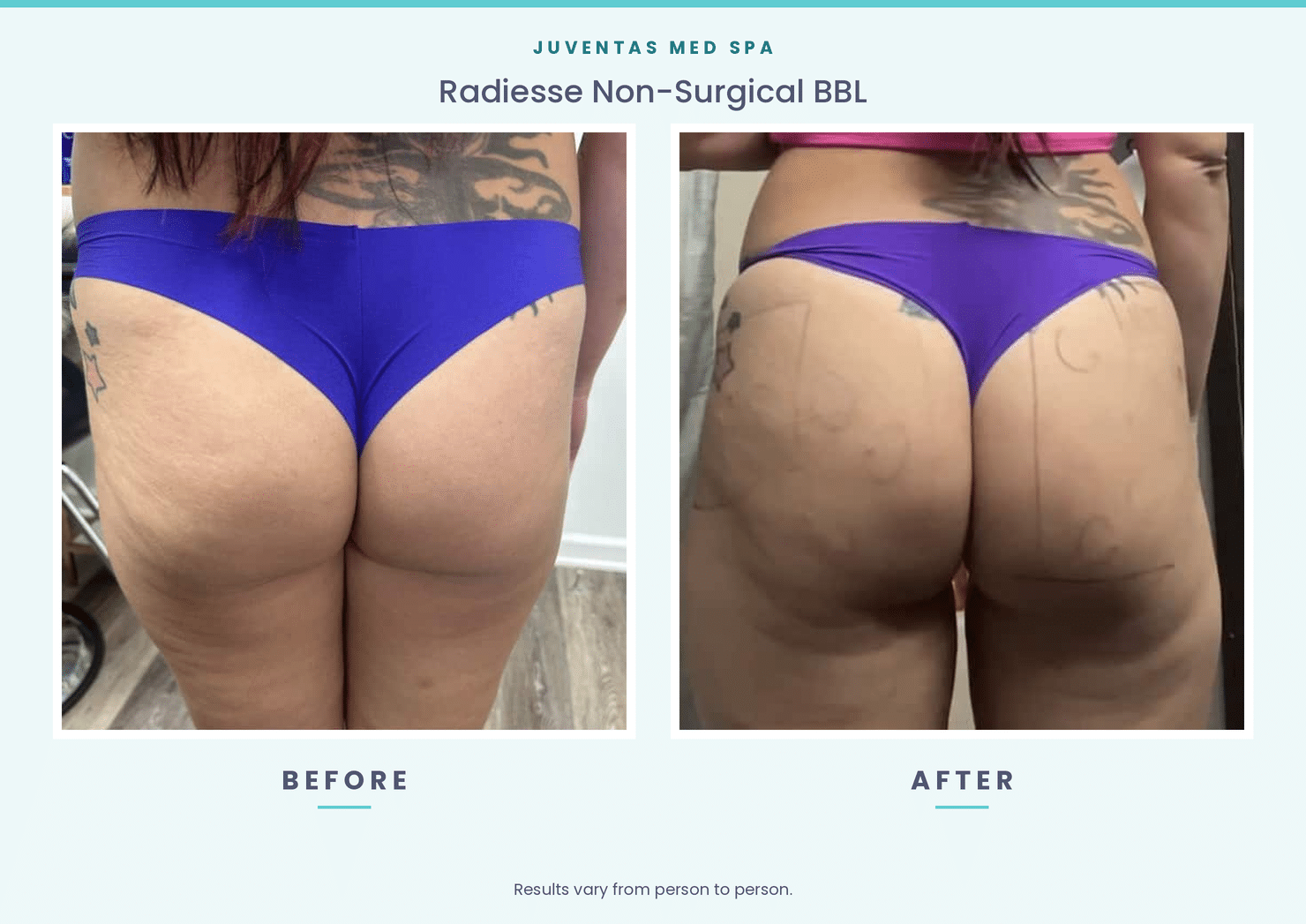 Before and after photos of a Radiesse non-surgical BBL at Juventas Med Spa